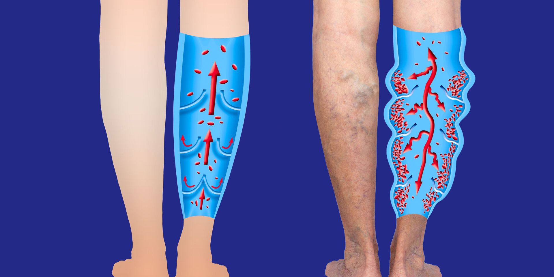 Symptomanalyse Thrombose